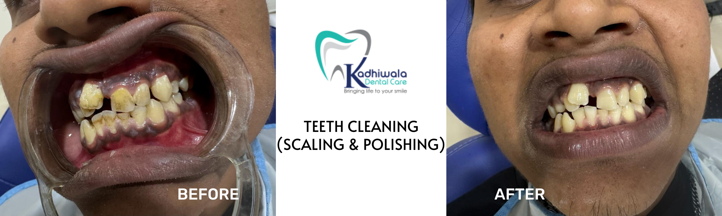 Achieving Dental Wellness: Experience Teeth Cleaning at Kadhiwala Dental Clinic